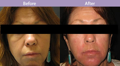 Fillers-Same Day Results (Dr.Besnoff&apos;s Patient)