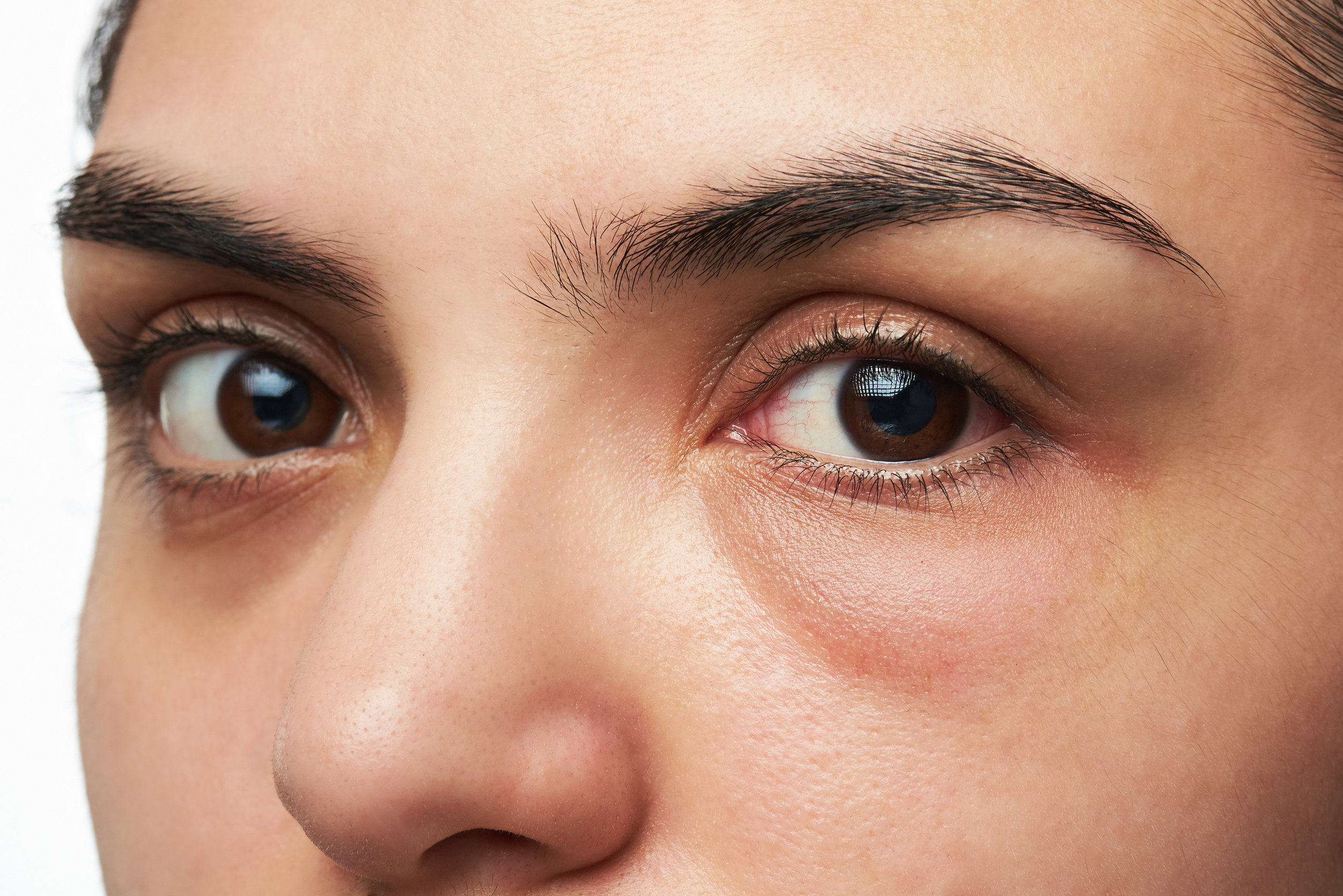 Why Lasers or PRP Under Eyes Don't Work for Puffy Eye Bags